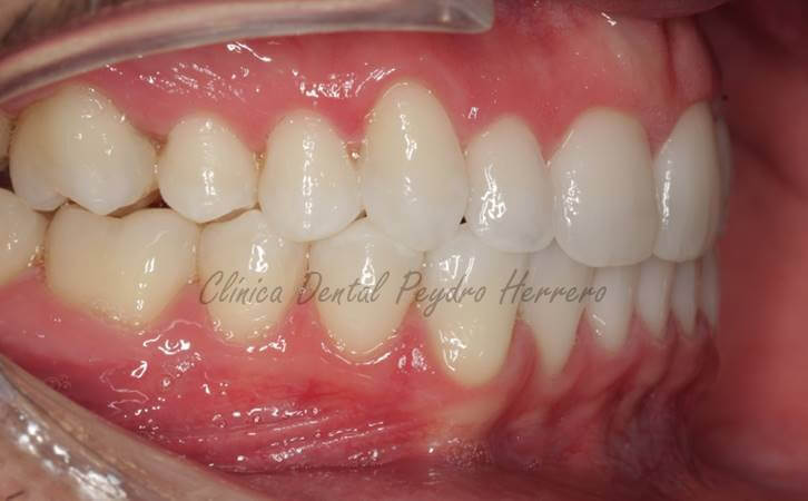 Tratamiento para Maloclusión dental severa