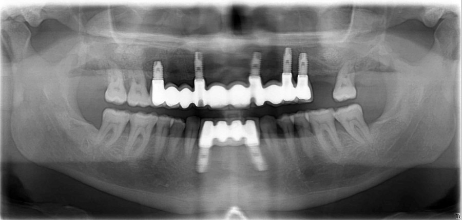 implantes dentales inmediatos