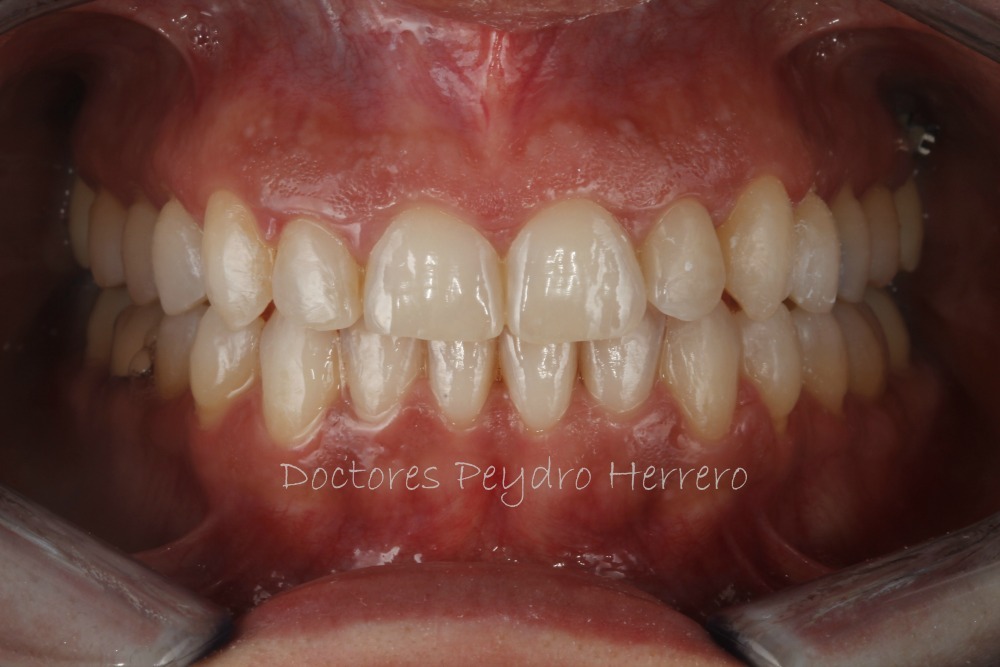 ortodoncia sin extracciones