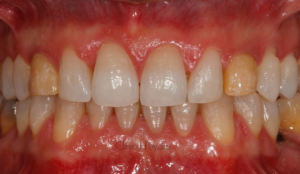 dientes manchados por tetraciclinas