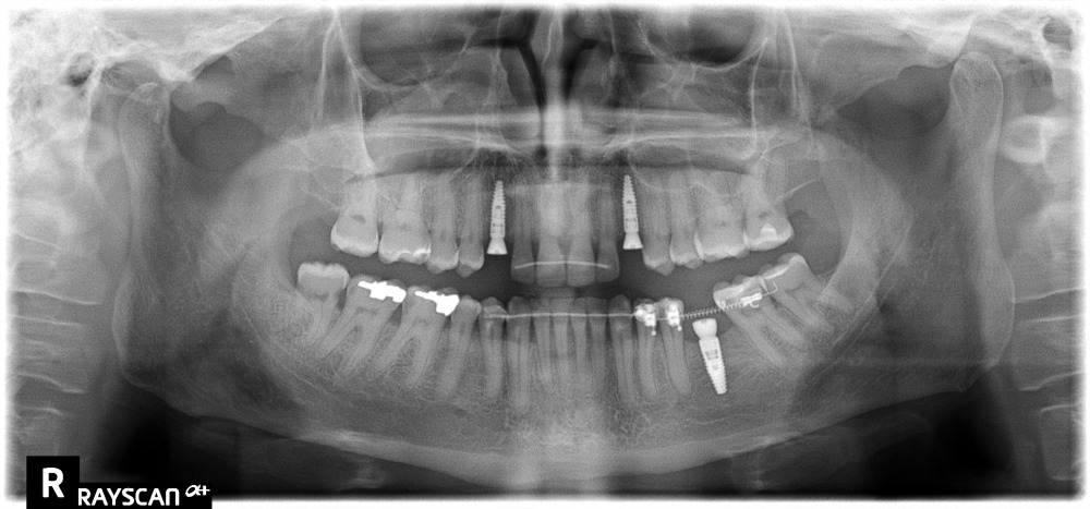 dientes manchados por tetraciclinas