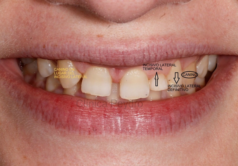 agenesia dental