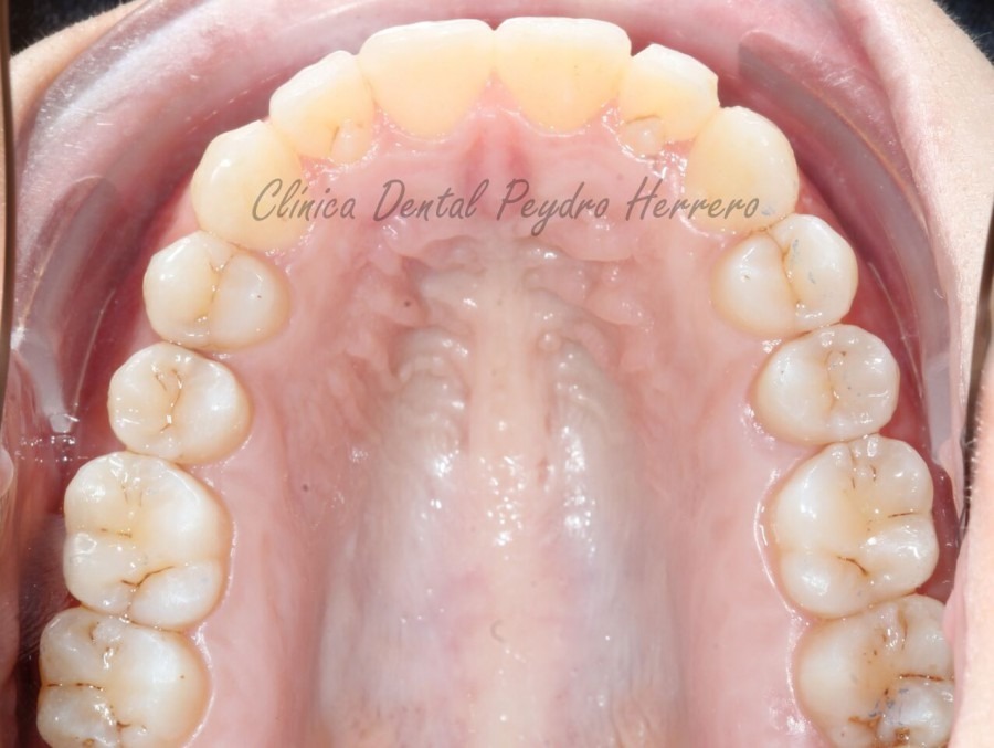 corregir la sonrisa gingival con ortodoncia