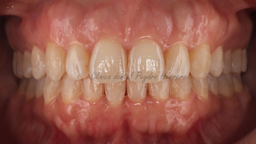 corregir la sonrisa gingival con ortodoncia