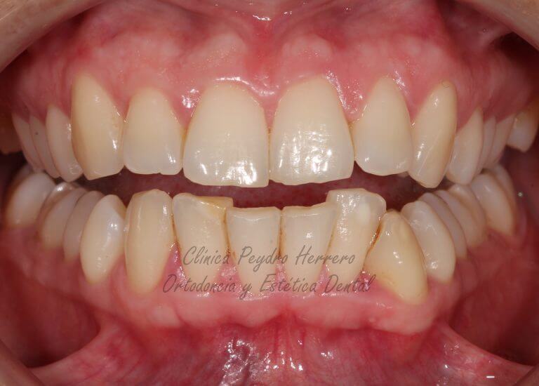 apiñamiento dental y dientes oscuros