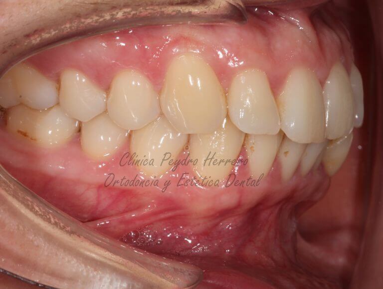 apiñamiento dental y dientes oscuros