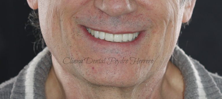 ortodoncia Invisalign