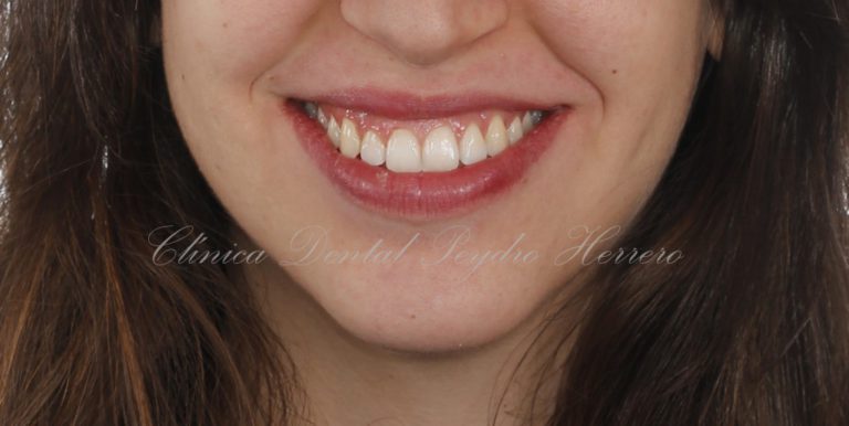 ortodoncia Invisalign