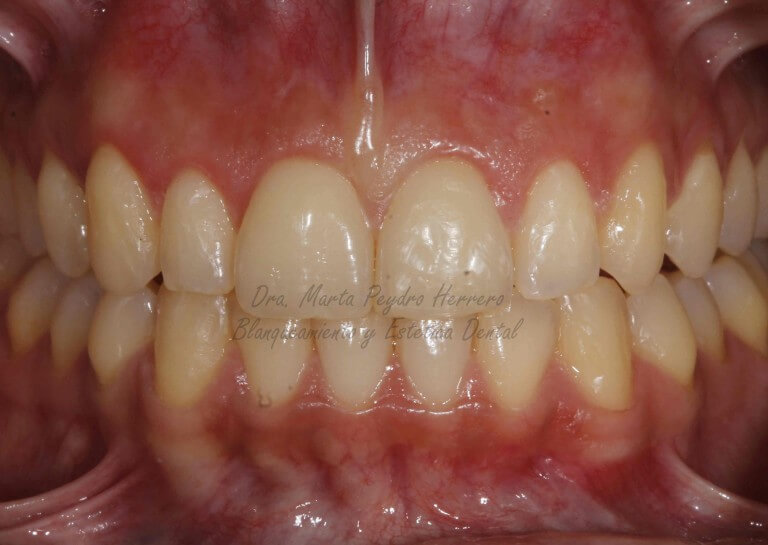 Aspecto tras la ortodoncia, previo al blanqueamiento dental