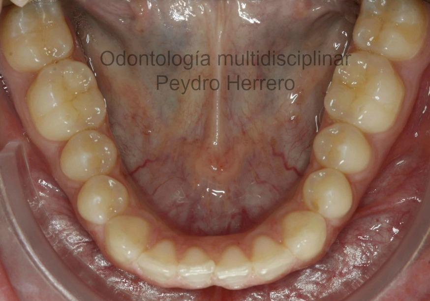 sonrisa gingival con ortodoncia invisible