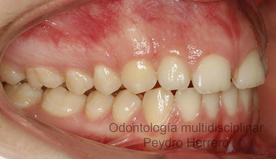 sonrisa gingival con ortodoncia invisible