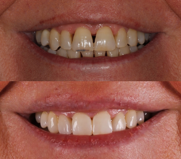 * Fotografía de la boca de la paciente antes y después del tratamiento