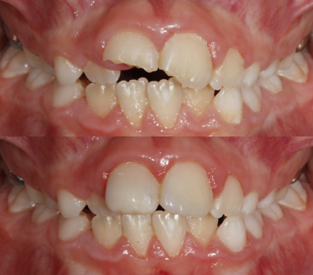 Fotografía del antes y después del tratamiento