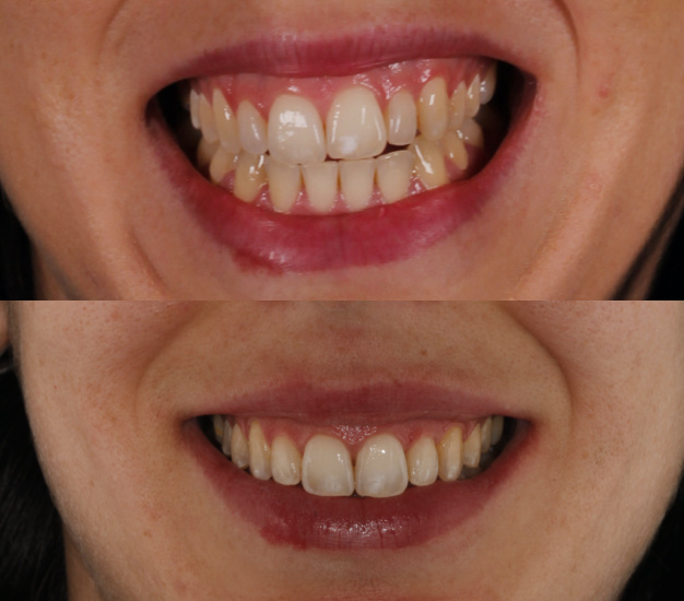 * Fotografía de la paciente antes y después del tratamiento