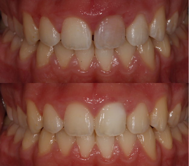 * Fotografía del pacientes antes y después del tratamiento de blanquemaiento dental
