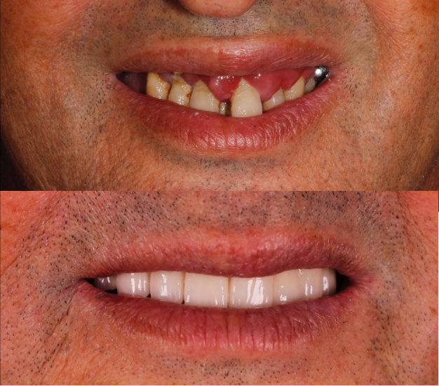 *Fotografía del antes y después del paciente tras su tratamiento de implantes