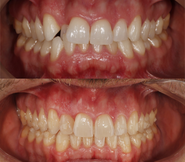* Fotografía frontal del paciente antes y después del tratamiento