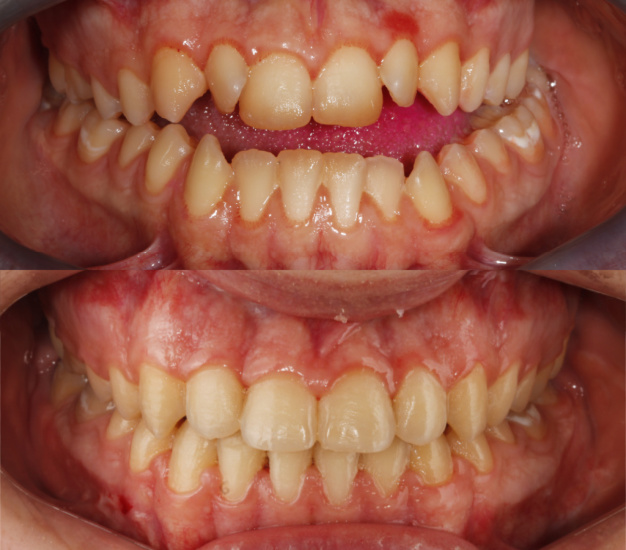 *Fotografía de los dientes del paciente antes y después del tratamiento
